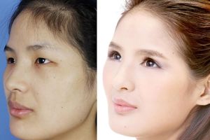 SKANDAL U KINI: Operišu očne kapke kako bi što više ličile na žene sa zapada
