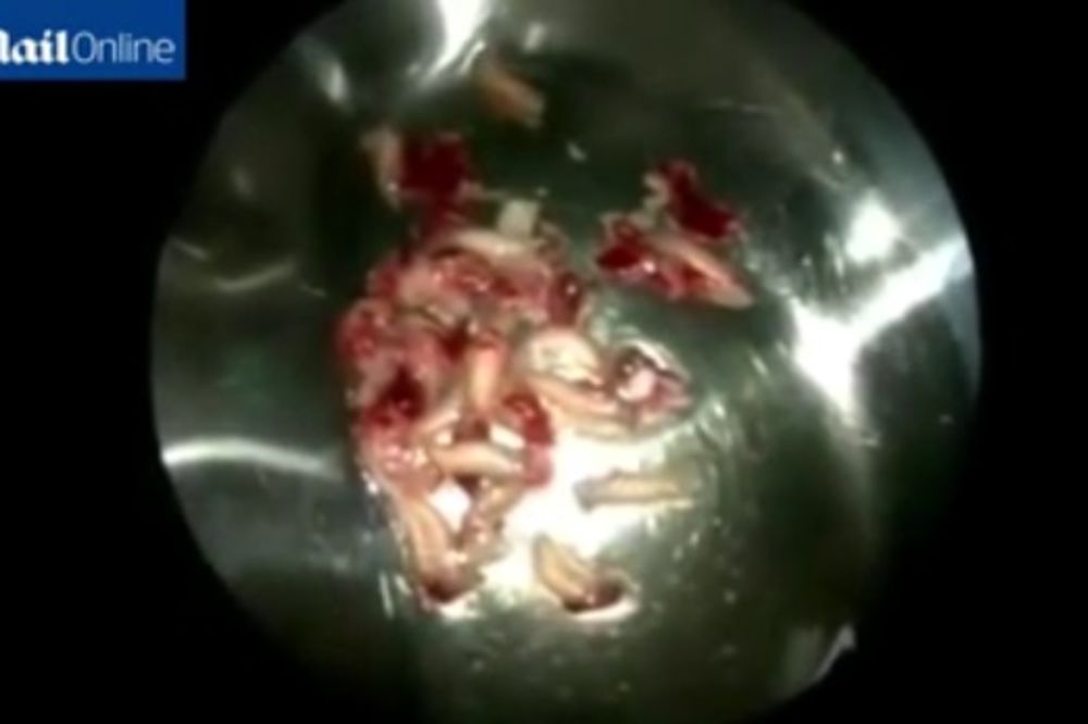 (VIDEO) Hirurzi mu izvadili 50 crva iz nosa pre nego što su mu počeli jesti oči