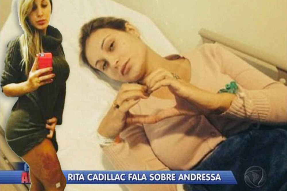 HOROR ISTRULILI JOJ MIŠIĆI: Brazilskoj lepotici ugrožen život zbog kolagena u butinama i zadnjici!