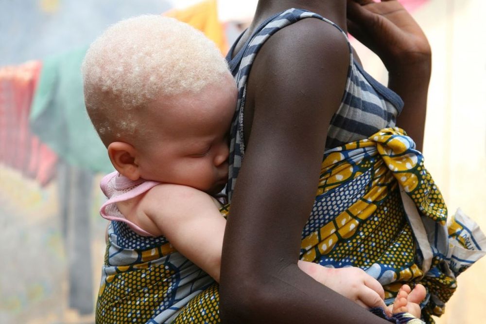 UBIJAJU IH ZBOG SUJEVERJA: Albino ljude u Tanzaniji prodaju porodice za 75 hiljade dolara!