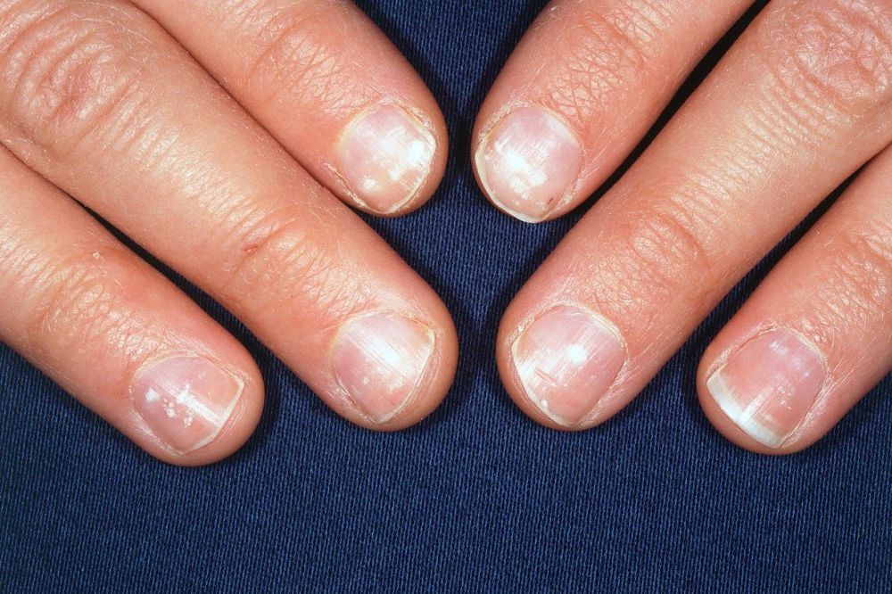 NEDOSTATAK KALCIJUMA JE MIT: Evo zašto se pojavljuju bele fleke na noktima