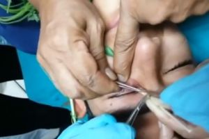 (VIDEO) NIJE ZA ONE SA SLABIM ŽELUCEM: Tinejdžeru (17) iz oka izvadili crva od 3 cm!