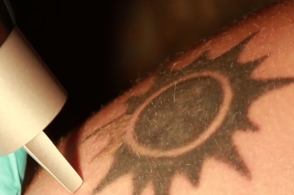 (VIDEO) SAMO ZA ONE KOJI SU SE POKAJALI: Ovako izgleda lasersko skidanje tetovaža