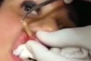 (VIDEO) NAJODVRATNIJI SNIMAK IKADA: Trenutak kada doktor iz usne devojke vadi ogromnog crva!