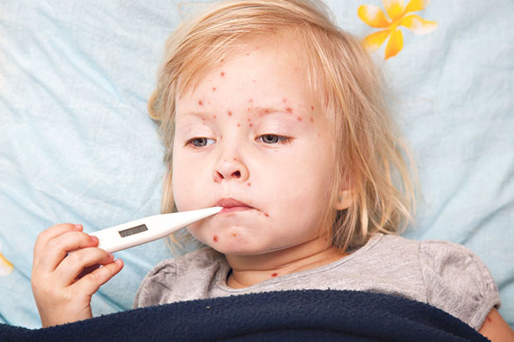 PANIKA NA NOVOM BEOGRADU: Roditelji zabrinuti zbog epidemije varičela. Evo šta kažu stručnjaci