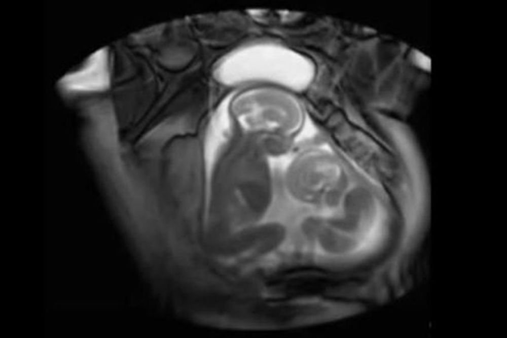(VIDEO) Svađa u materici: Pogledajte kako se blizanci ćuškaju u maminom stomaku