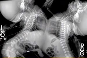 (VIDEO) Doktori su rekli da sijamske bliznakinje neće preživeti razdvajanje. Da li su bili u pravu?