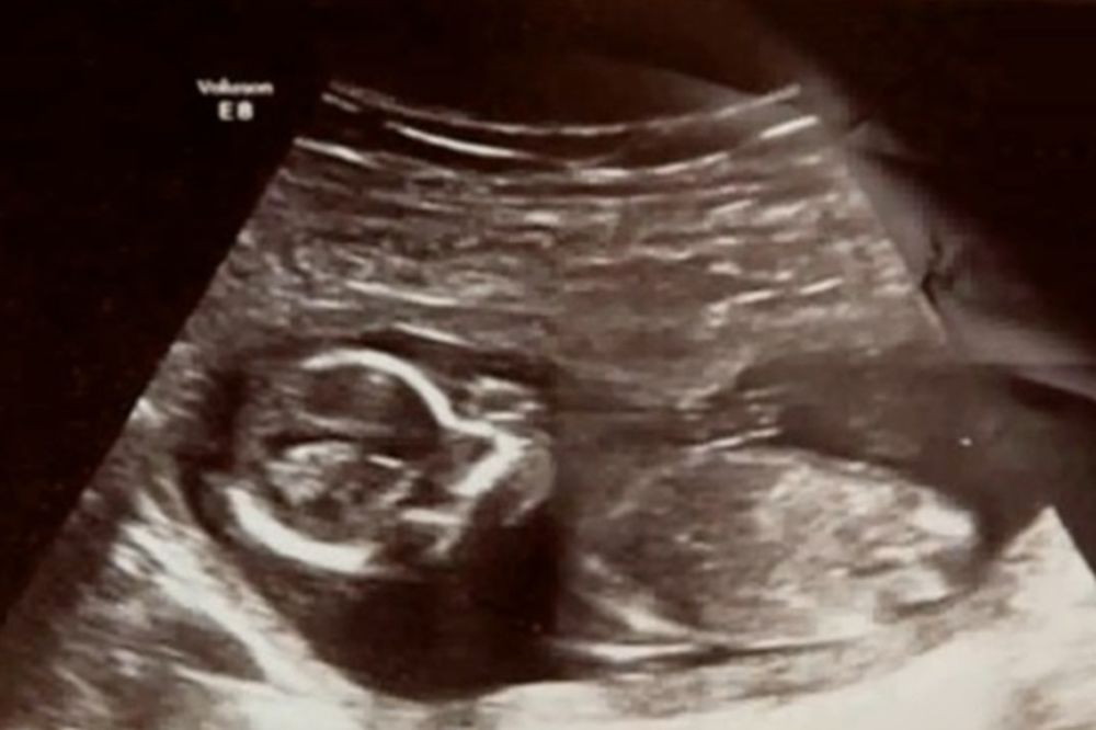 (VIDEO) DOKTORI SU BILI U ŠOKU: 10 dana posle pobačaja čuli su bebine otkucaje srca...