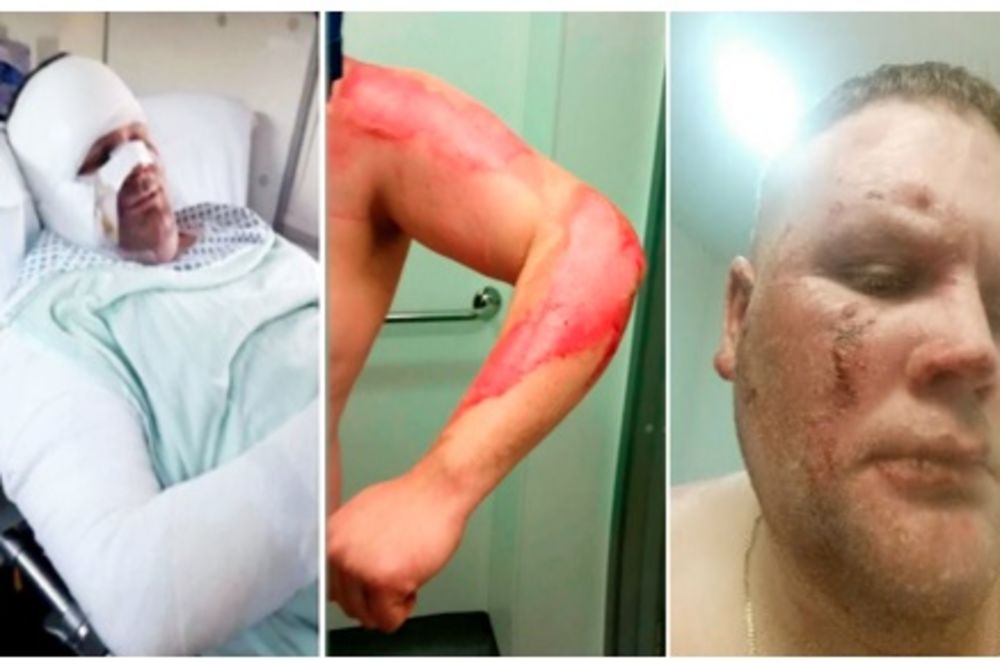 OPASNOST: Čovek hitno primljen u bolnicu kada mu je elektronska cigareta eksplodirala u lice!