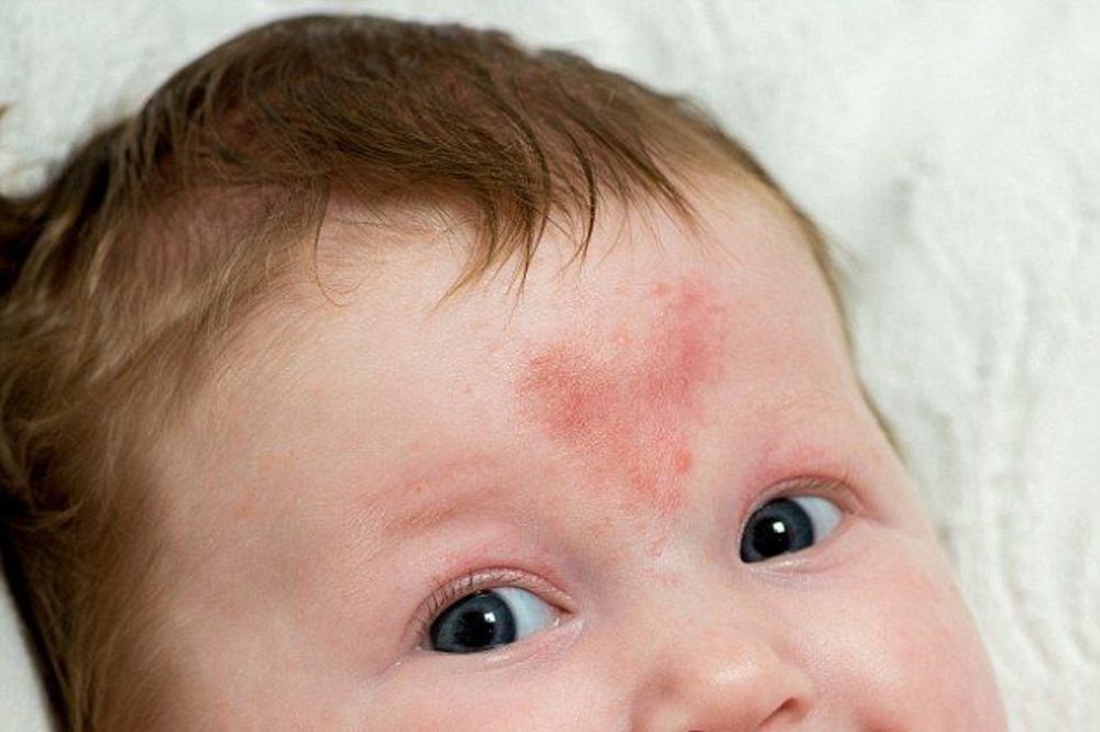 NEVEROVATNO! Beba začeta na Dan Zaljubljenih rođena sa belegom u obliku srca na sred čela!