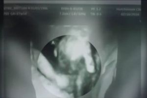 (VIDEO) DOKTORI SU REKLI DA JEDAN BLIZANAC NEĆE PREŽIVETI: Onda je ultrazvuk pokazao čudo...
