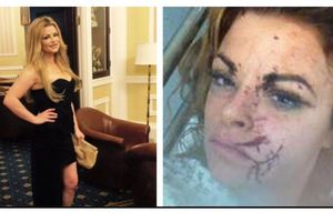 (UZNEMIRUJUĆE) Isekli su je slomljenom čašom po licu u klubu, a ona je podelila jezive slike povreda