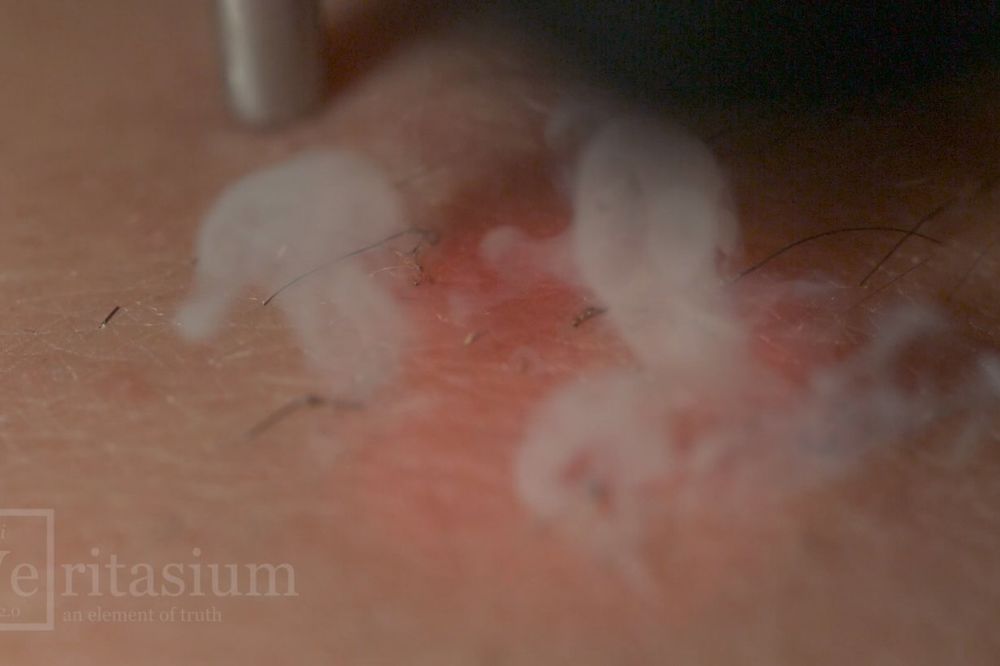 (VIDEO) ZASTRAŠUJUĆ PRIZOR: Pogledajte kako laserska epilacija izgleda na usporenom snimku