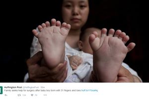RODITELJI MOLE ZA POMOĆ: U Kini rođena beba 15 prstiju na rukama i 16 na nogama