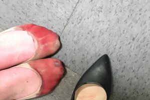 (FOTO) GAZDA IZ PAKLA: Krvava stopala konobarice zgrozila su internet