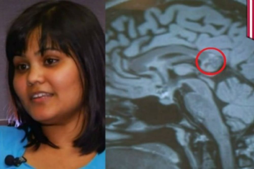 UŽASAVAJUĆA PRIČA: Doktori pronašli zlog blizanca u njenom mozgu!
