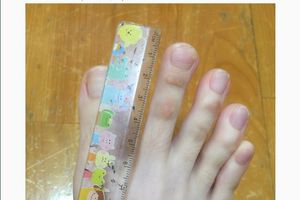 (FOTO) SVETSKA MEDICINA U ŠOKU: Ima prste na nogama dugačke 5 centimetara!