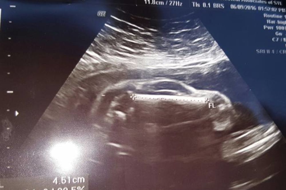 TRUDNICA OSTALA U ŠOKU: Na ultrazvuku njena beba izgledala je kao auto!