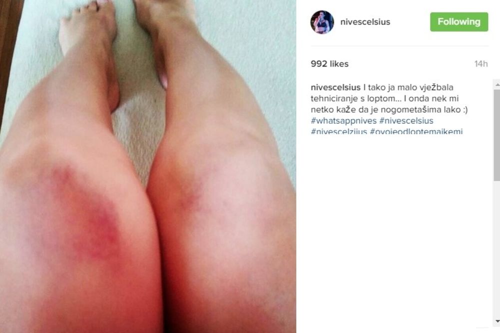 (FOTO) HRVATSKA PEVAČICA ŠOKIRALA OBJAVOM: Njene modre noge su zaprepastile sve