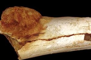 Najstariji karcinom pronađen na kosti fosila starog 1,7 miliona godina