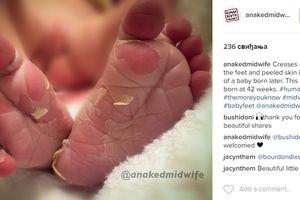 (FOTO) Ugledala je oljuštena stopala kod svoje bebe i to je bio znak upozorenja! Evo šta to znači