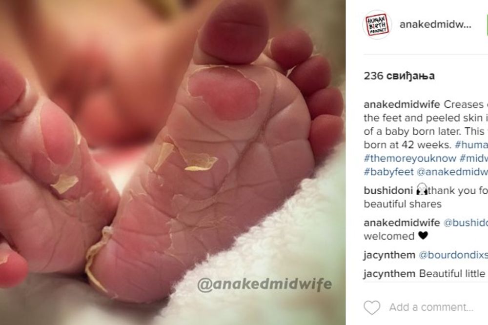 (FOTO) Ugledala je oljuštena stopala kod svoje bebe i to je bio znak upozorenja! Evo šta to znači
