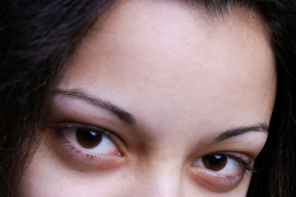 NE ČEKAJTE POSLEDNJI TRENUTAK: Ako imate crne podočnjake ispod očiju, ODMAH idite kod lekara!