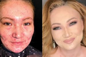 (VIDEO) NEVEROVATNA TRANSFORMACIJA: Ona je šminkom prekrila devojci teške akne! Ovo je njen trik!