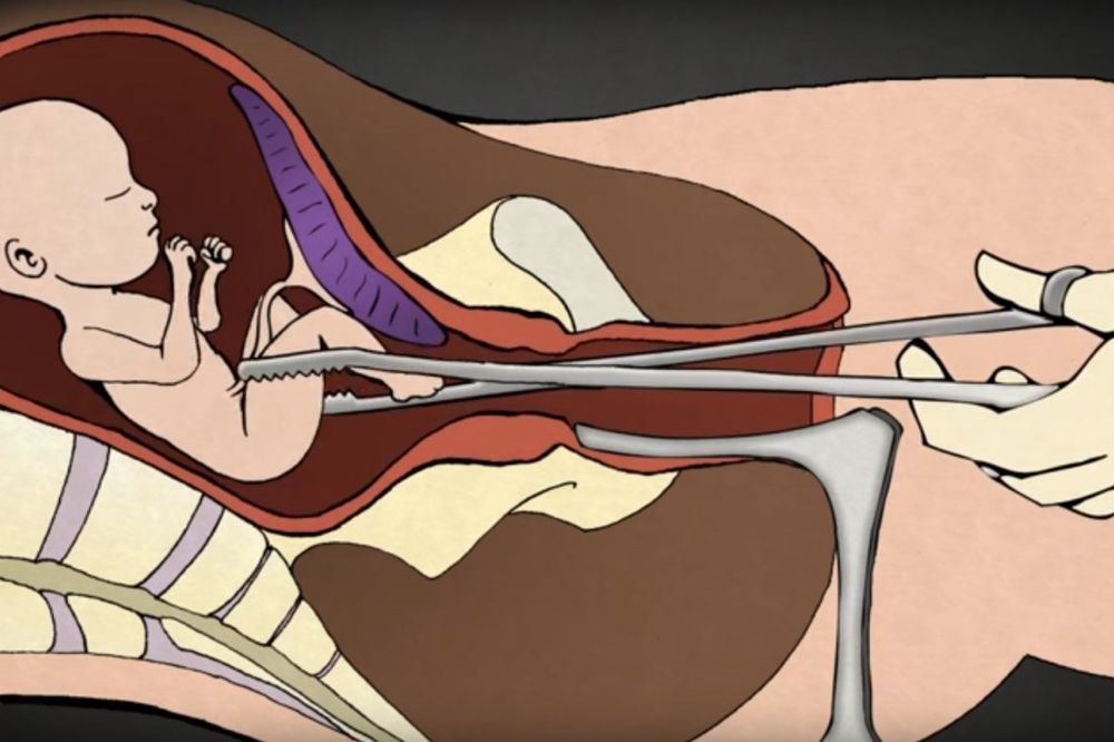 (UZNEMIRUJUĆI VIDEO) LOME BEBI DELOVE TELA: Doktor koji je izveo 1.200 abortusa objasnio ceo proces!