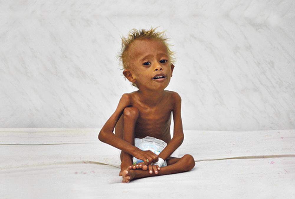 Potresno... Neuhranjeno dete u Jemenu