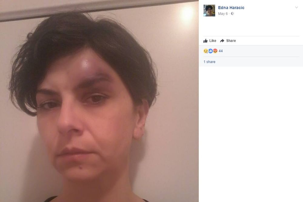 TUKAO JE PO LICU: Šokantne fotke pretučene žene preplavile Fejsbuk, nasilnik priveden pa PUŠTEN!