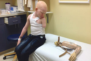 KASAPILI IH KAO U MESARI: Albino dečaci dobili nove udove