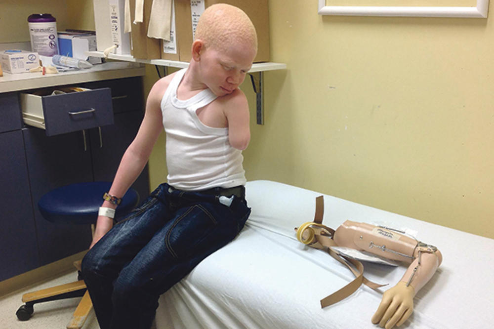 KASAPILI IH KAO U MESARI: Albino dečaci dobili nove udove
