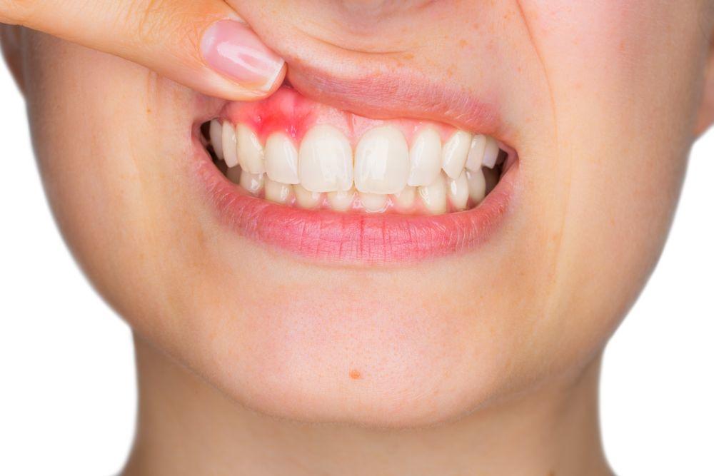 Desni, Zubi, Ispadanje Zuba