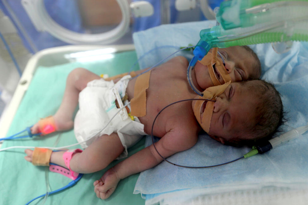 (FOTO) ČUDO KOJE SE NE VIĐA SVAKI DAN: U Gazi rođene spojene bliznakinje