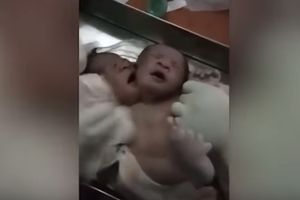 (UZNEMIRUJUĆI VIDEO) ŠOK! ROĐENA BEBA SA DVE GLAVE: Tužna sudbina sijamskih blizanaca iz Indije će vas rasplakati