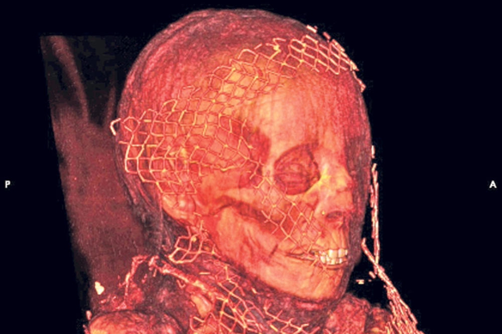 ISTRAŽIVANJE: Rak dojke nađen na mumiji iz Egipta staroj 20 vekova!