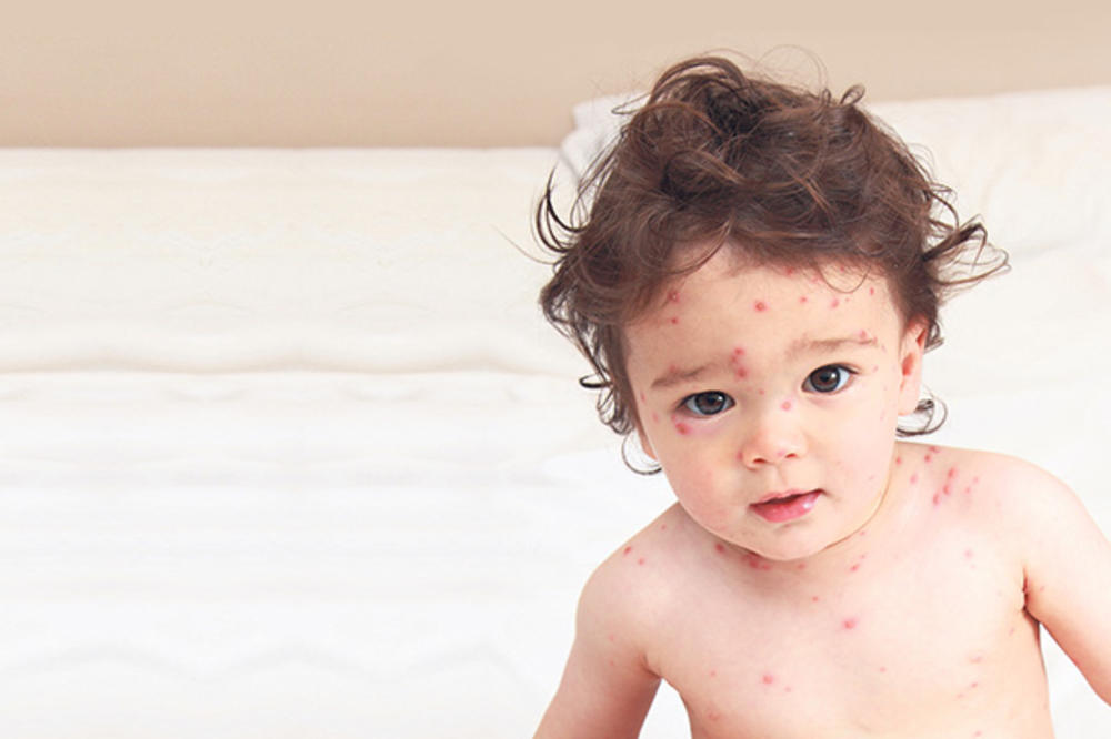 ŠOK U VRTIĆU U BEOGRADU: Vakcinisano dete dobilo morbile?