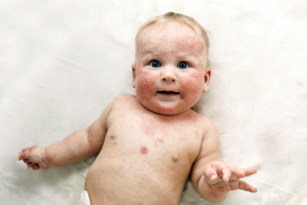 RODITELJI, PAŽNJA: Mamin poljubac zarazio bebu herpesom