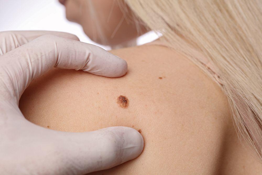 OBOLELIMA OD MELANOMA DOGODINE NOVA SAVREMENA TERAPIJA: Uključuje dva leka, u primeni je od 2017. godine i biće na račun RFZO