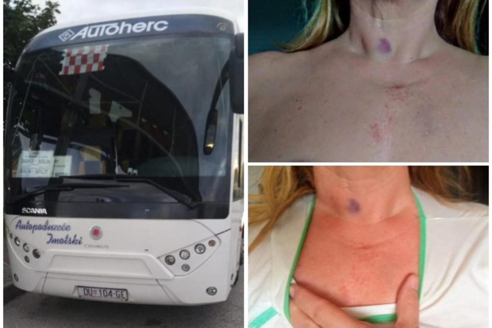 HOROR U HRVATSKOJ: Vozač autobusa pretukao ženu pred  unukom (4) i ćerkom zbog parčeta pice! DETE NE SPAVA DVA DANA! (FOTO)