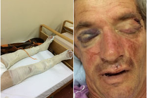 UŽAS U BANJALUCI: Penzioneru metalnim šipkama polomili obe noge, brutalno ga pretukli na kućnom pragu