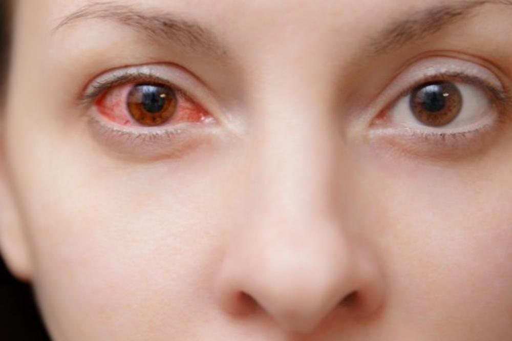 EPIDEMIJA AGRESIVNOG OČNOG GRIPA U AUSTRIJI: Zarazna infekcija ubrzano se širi,  a može trajno da ošteti vid!