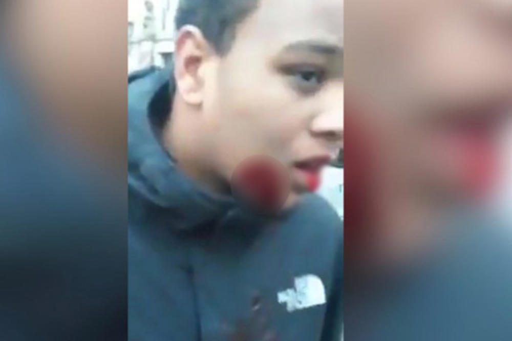JEZIV SNIMAK IZ PARIZA: Mladić sa rupom na licu iz koje šiklja krv! Kao da ga ništa ne boli! (UZNEMIRUJUĆI FOTO, VIDEO)