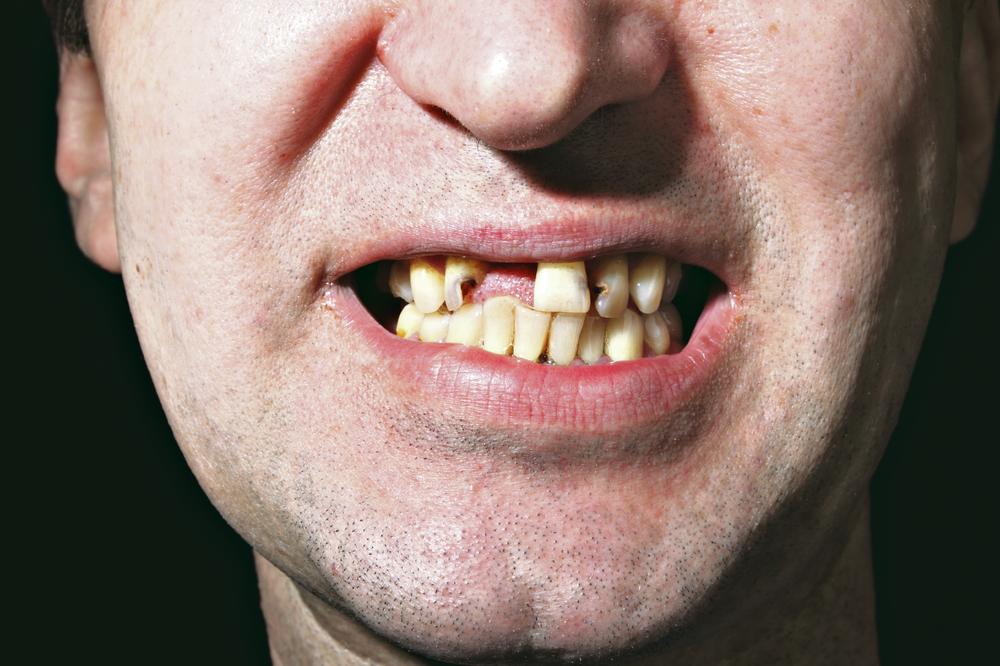 VELIKO OTKRIĆE JAPANSKIH NAUČNIKA: Uspešno testirali lek koji stimuliše rast novih zuba! OSTAO JOŠ SAMO JEDAN KORAK