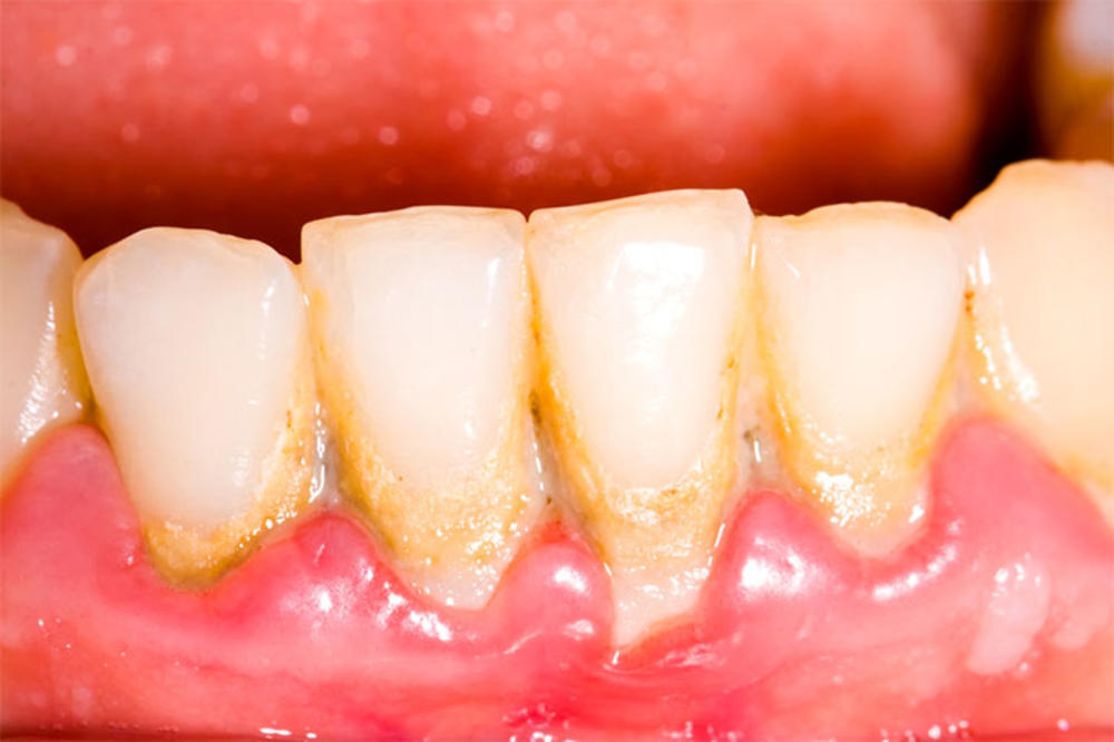 IZBEGNITE PARADENTOZU: Ako ovo budete redovno radili, smanjujete šanse za oboljenje zuba i desni!