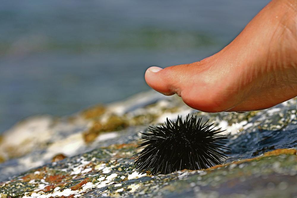 KAKO PRUŽITI PRVU POMOĆ? Evo šta treba da radite kada zgazite ježa na moru!