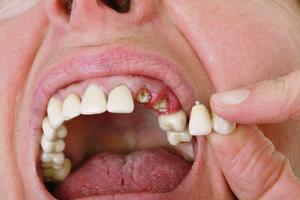 GADNA STATISTIKA, KREZUBA SKORO CELA SRBIJA: Neverovatan podatak, sve zube ima samo 16 odsto odraslih u našoj zemlji