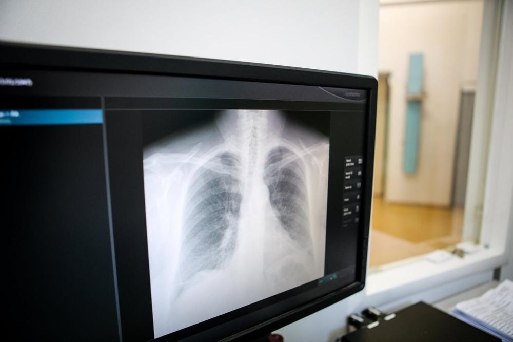 OD SLEDEĆE GODINE SKRINING ZA RANO OTKRIVANJE RAKA PLUĆA: U porastu broj pacijenata sa rakom pluća u Vojvodini!