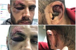 (UZNEMIRUJUĆE FOTOGRAFIJE) Makedonski fudbaler brutalno pretučen u Hrvatskoj: Napali ga štanglom i napravili rane na glavi! Zatvoreno mu oko i koža oguljena sa čela!